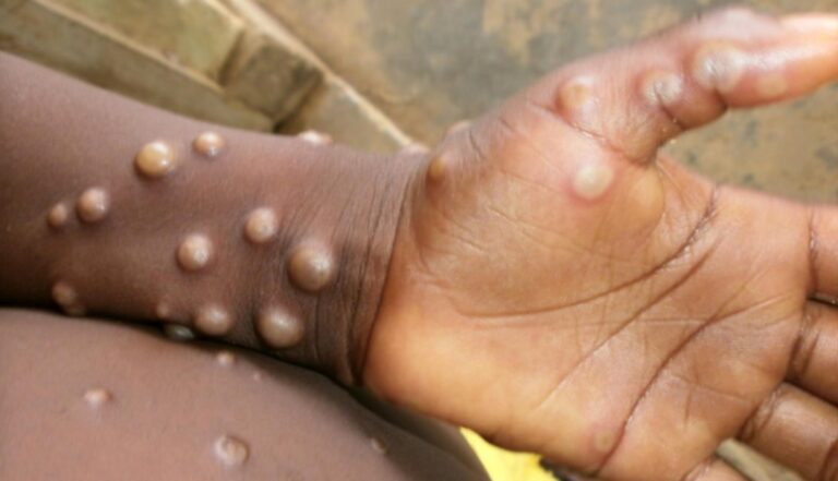 NCDC confirms 31 new monkeypox cases